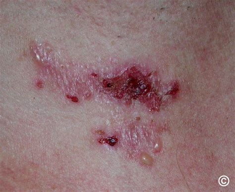 Dermatitis Herpetiformis
