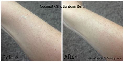Stopping Sunburn Skin Peeling