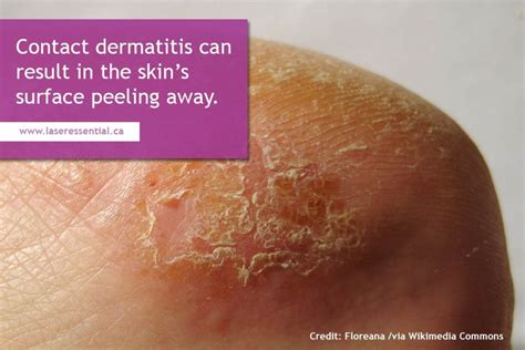 Eczema And Your Skin What You Need To Know Laser Essential And Skin Care