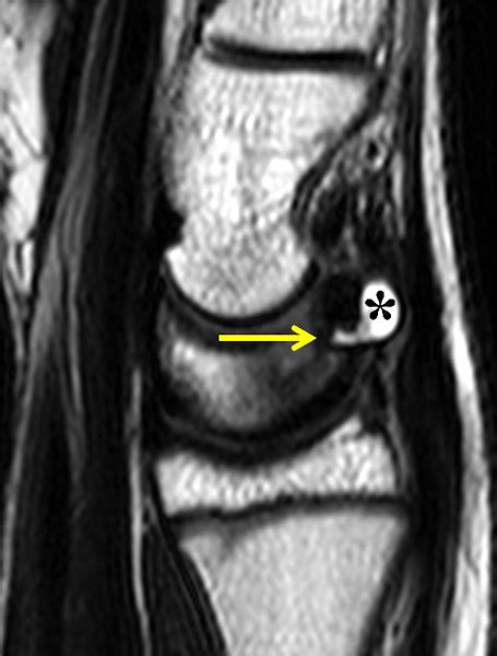 Ganglion Cyst Wrist X Ray