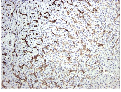 Immunolabeling With Cd34 Brown Staining The Border Of A