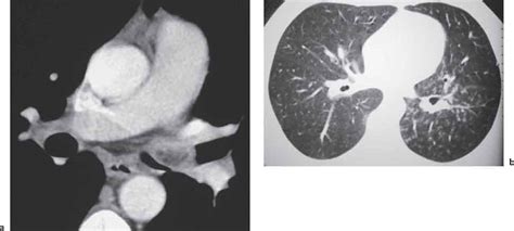 Tumors And Tumor Like Lesions Of The Lung Radiology Key