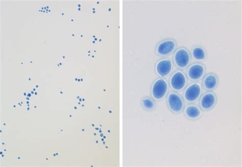 Disseminated Cryptococcosis With Meningitis Peritonitis And