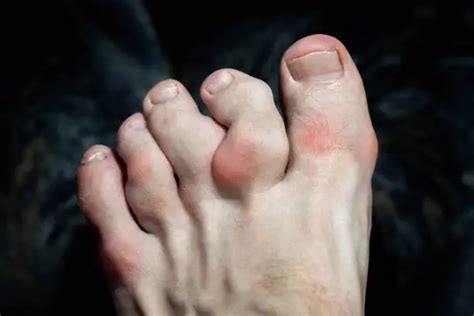 Arthritis In Toes Types Symptoms Treatment Exercise