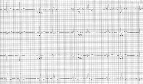 Ecg Learning Center An Introduction To Clinical Electrocardiography