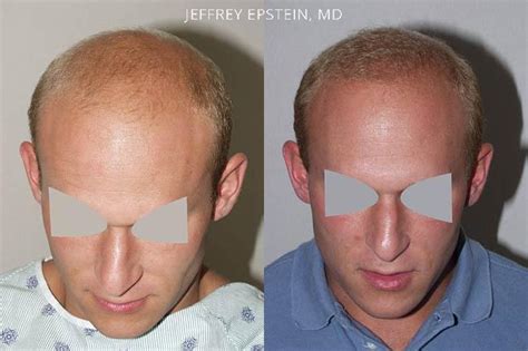 Hair Transplants For Men Photos Miami FL Patient39262