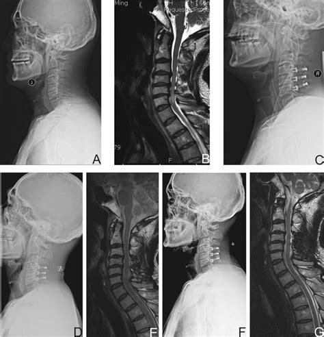 A 54 Year Old Male With Multi Levels Cervical Spondylotic Myelopathy