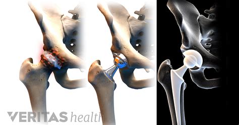 Advantages And Disadvantages Of Anterior Hip Replacement