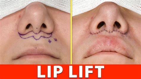 Lip Lift Full Procedure In 4k Graphic Youtube