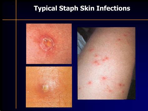 Ppt Staphylococcus Aureus Skin Infections Powerpoint Presentation