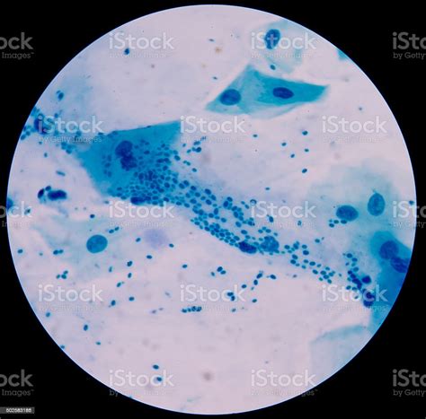 Branching Budding Yeast Cells With Pseudohyphae In Sputum Gram S Stock