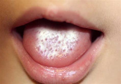 Oral Thrush In Babies And Toddlers Caring Momster