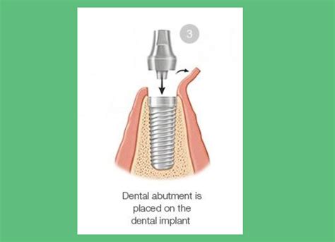 What Is Dental Implant Procedure Step By Step With Pictures Dental Blog