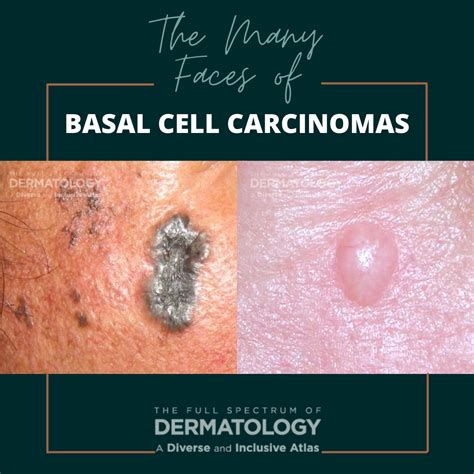 The Many Faces Of Basal Cell Carcinomas Bccs Next Steps In Dermatology