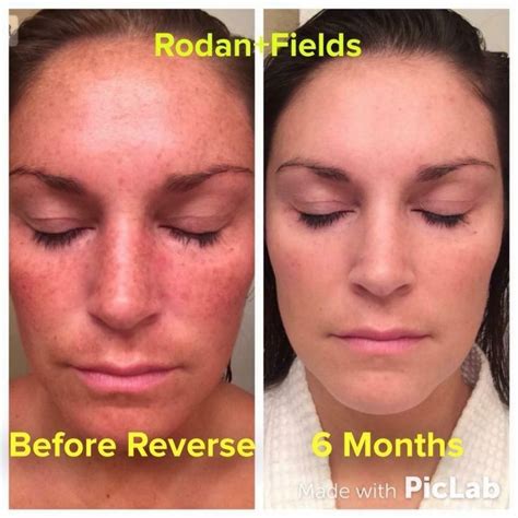 Aromatherapy Skin Care Rodan And Fields Rodan And Fields Reverse Rodan