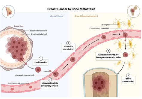 Breast Cancer Metastasis To The Bone Microenvironment Young Scientist Journal Vanderbilt
