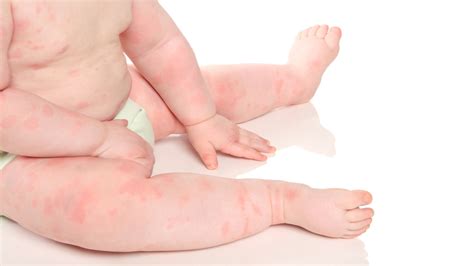 Roseola Causes Treatment And Prevention