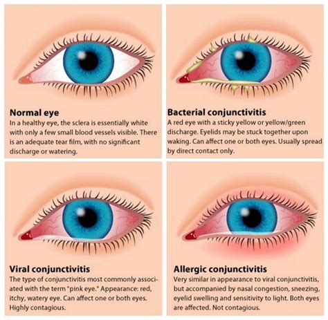 Pink Eye Conjunctivitis Symptoms Treatments And Prevention