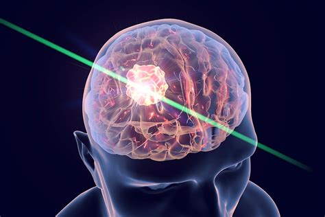 Lasers Help Fight Deadly Brain Tumors Washington University School Of