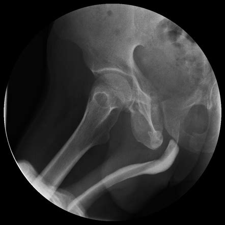 Retrograde Pericatheter Urethrogram Normal Image Radiopaedia Org