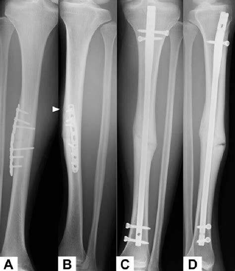 Recurrent Fracture After Anterior Tension Band Plating With Bilateral