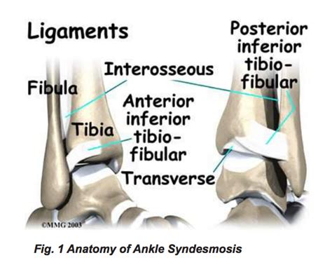 Ankle Sprain Anatomy Anatomy Drawing Diagram