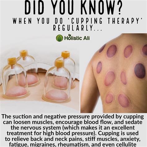 Do You Know Cupping One Report Published In 2015 In The Journal Of Traditional And