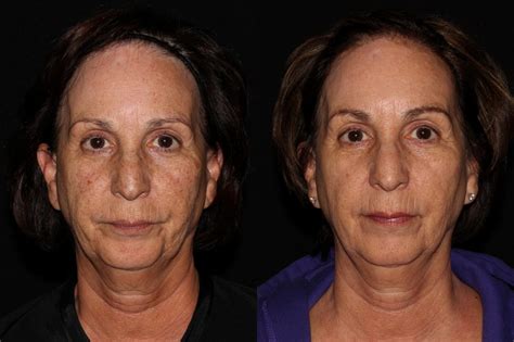 BBL PhotoFacial Before And After Pictures Case Chico Yuba City Oroville CA Hodari