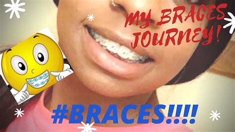 Getting Braces As An Adult My Journey Braces Vlogmust Watch Youtube