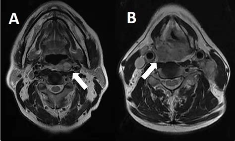 Frontiers Retropharyngeal Lymph Node Metastasis Diagnosed By Magnetic
