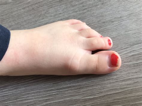 Lump On Two Year Olds Toe Photo Attached