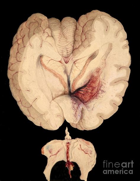 Unusual Cerebral Hemorrhage Photograph By Wellcome Images Pixels