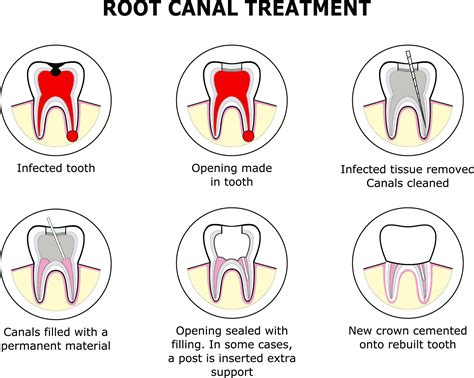 Root canal treatment – Pure Bliss Dental Care