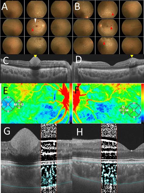 Initial Findings On Color Fundus Photography Cfp Swept Source