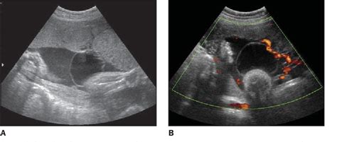 Figure 1 From Correlation Between Isolated Sonographic Finding Of