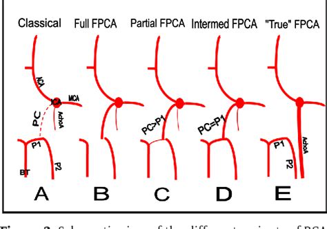 Figure From Duplication Of The Posterior Cerebral Artery Pca Or
