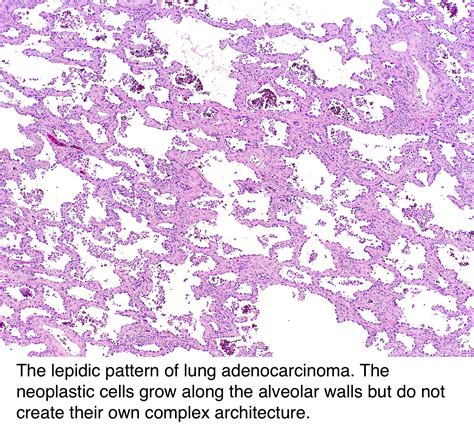 Pathology Outlines Adenocarcinoma Overview