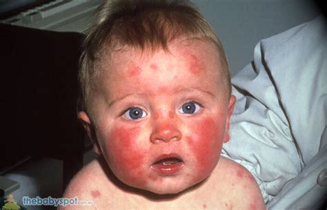 These rashes can usually be treated at home by washing the affected area with cool water and applying nonprescription antihistamines and calamine lotion. Ultimate Guide to Introducing Solids to Baby - 52 tips to ...