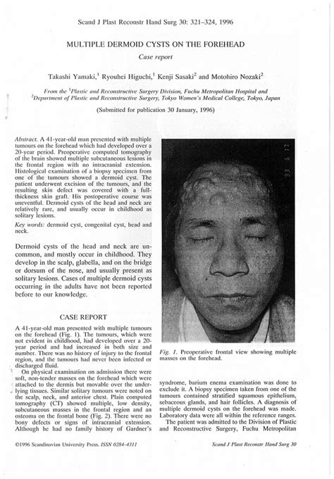 Pdf Multiple Dermoid Cysts On The Forehead Case Report