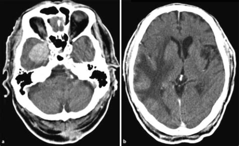 Edema A Mantellina E Esoftalmo - a Axial contrast-enhanced brain CT scan reveals a right | Open-i
