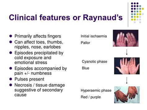 Ppt Raynauds Phenomenon Powerpoint Presentation Id3104002