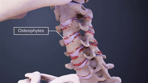 Cervical Osteophytes Bone Spurs In The Neck Spine Health