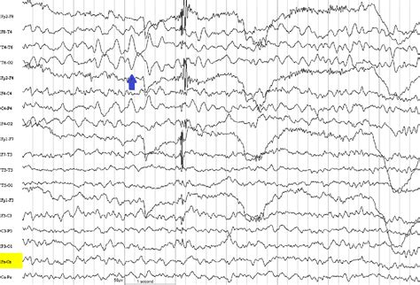 Positive Sharp Waves In The Eeg Of Children And Adults Semantic Scholar