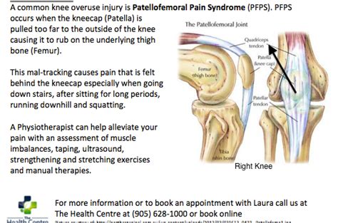 Patellofemoral Pain Syndrome Pfps