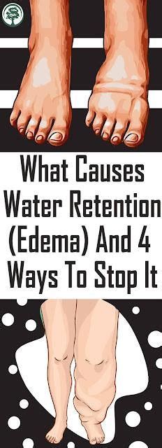 What Causes Water Retention Edema And 17 Ways To Stop It Rwellnessmgz6