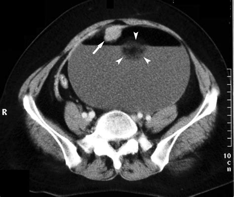 Atypical Ct And Mri Manifestations Of Mature Ovarian Cystic Teratomas Ajr