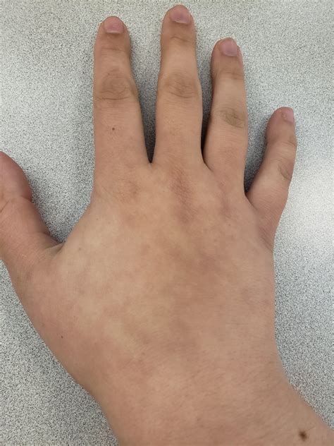 My Hands Look Like This When Ever Even Moderately Cold Fingers Feel