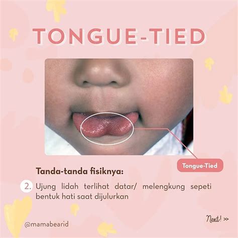 Apa Itu Tongue Tie Pada Bayi Tongue Tie Adalah Kondisi Frenulum Atau