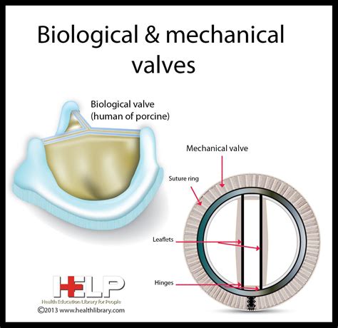 Mechanical Vs Prosthetic Heart Valve