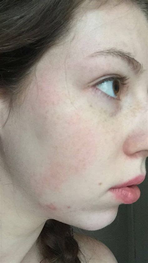 Skin Concerns Routine Help Dealing With Rosacea And The Same